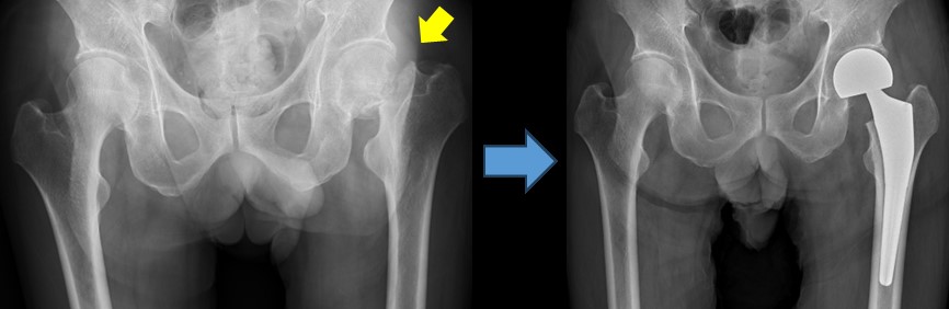 大腿骨近位部骨折の術前術後の画像1