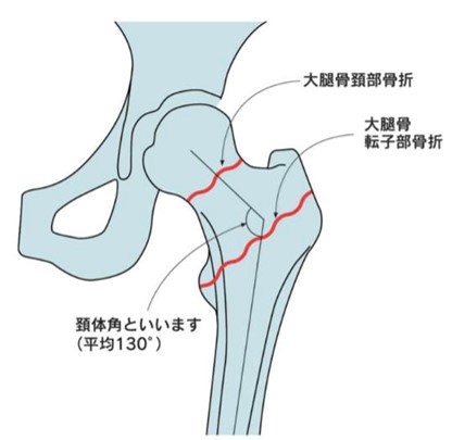 大腿骨近位部骨折の図