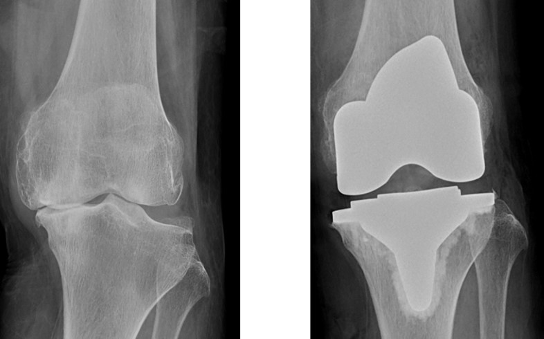 変形性膝関節症の術前術後の画像1