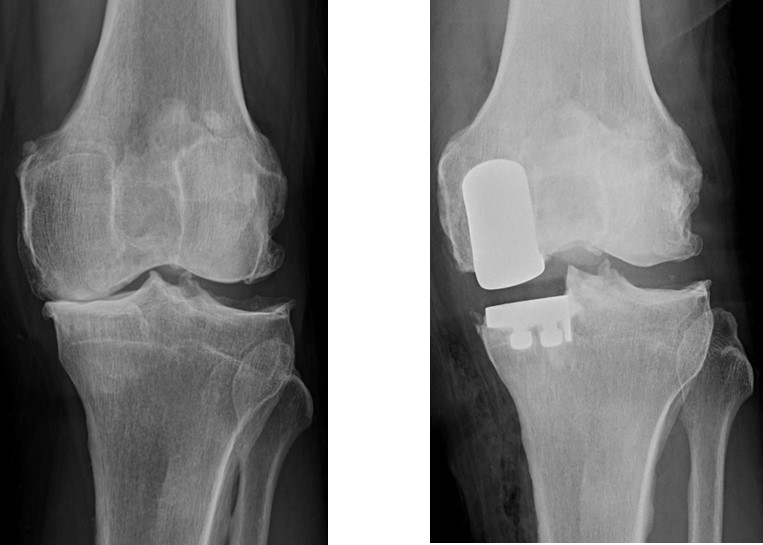 変形性膝関節症の術前術後の画像2