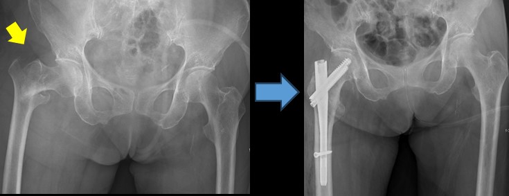 大腿骨近位部骨折の術前術後の画像2
